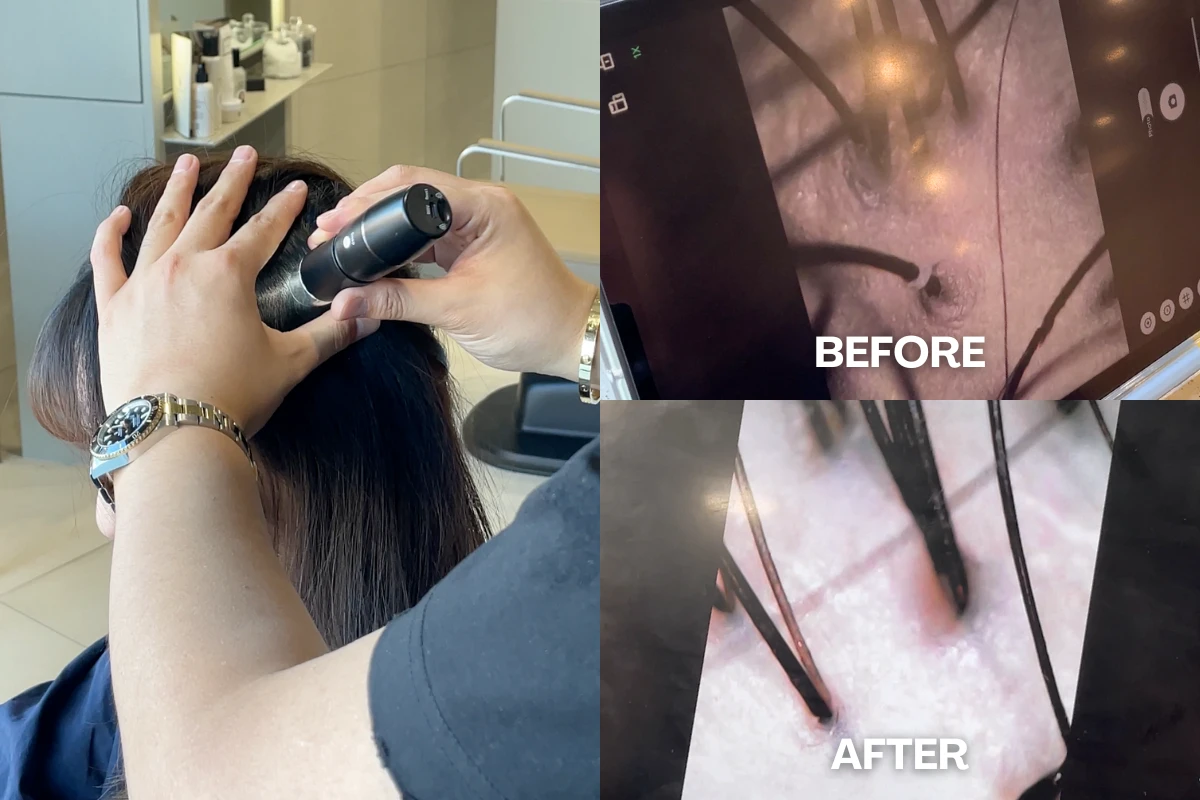Nhân viên salon dùng camera phóng đại da đầu bên cạnh ảnh cận cảnh trước và sau trên màn hình