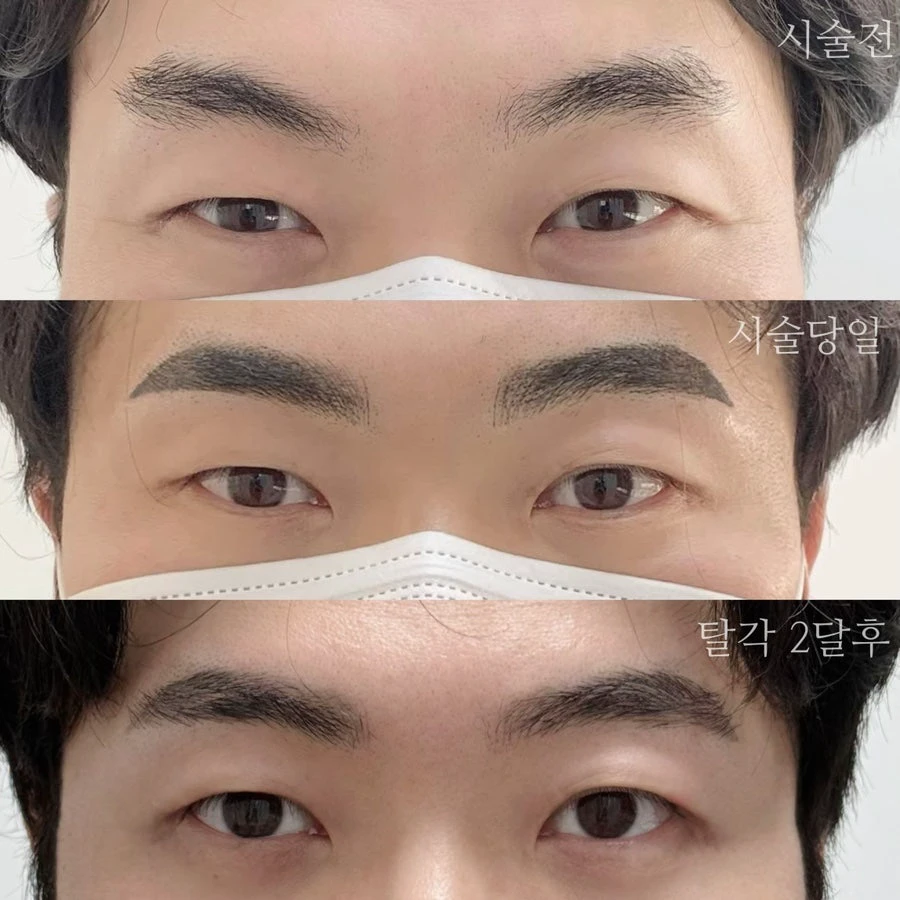 Client brow comparison labeled before, treatment day, and two months after peeling