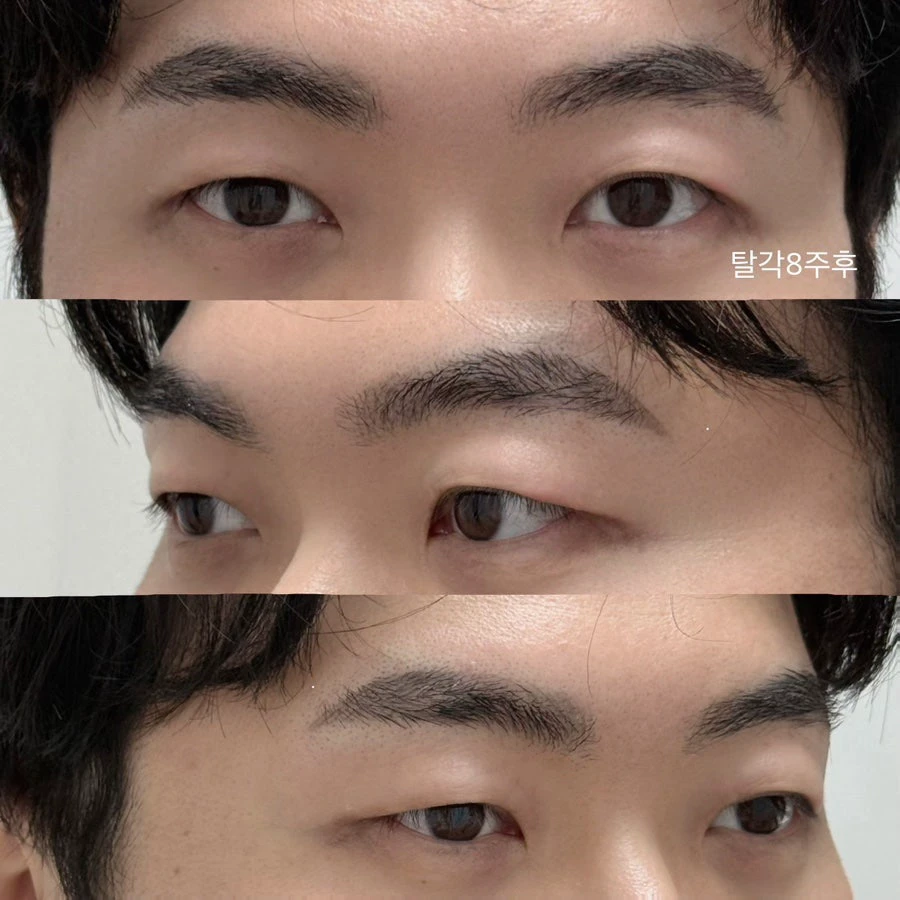 Three views of a client’s brows labeled eight weeks after the peeling stage